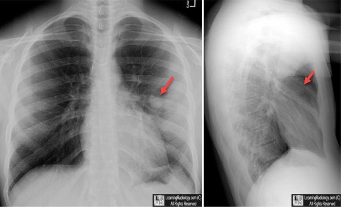 Pulmonary Hematoma